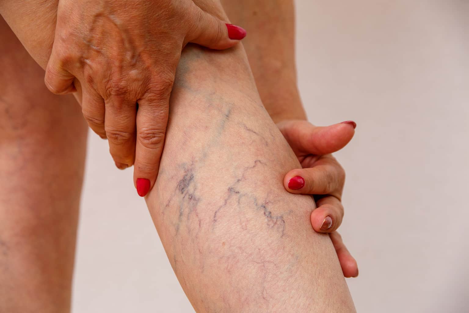 Woman with Closeup of Leg with Varicose Veins