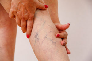 woman with varicose veins on legs
