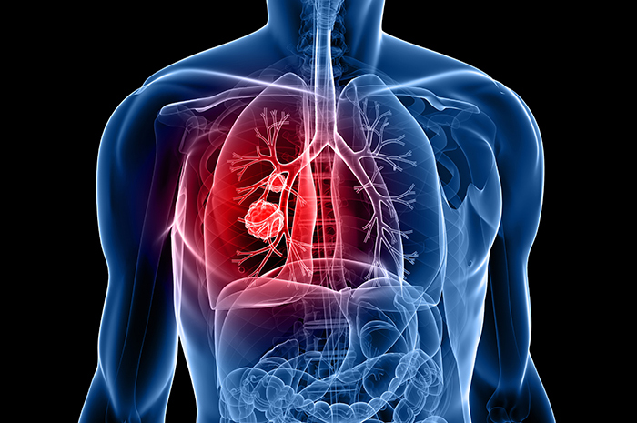 lung-cancer2