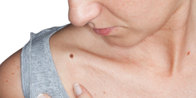 woman looking at mole on her collarbone, melanoma monday is still a thing, skin cancer, abnormalities in skin, asymmetry of moles, invasive melanoma, dr jenny liu, dr erin luxenberg hammer, dr sara hylwa