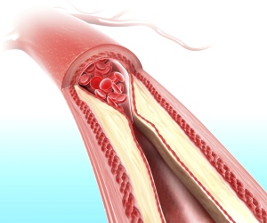 Cholesterol can cause plaque buildup in arteries